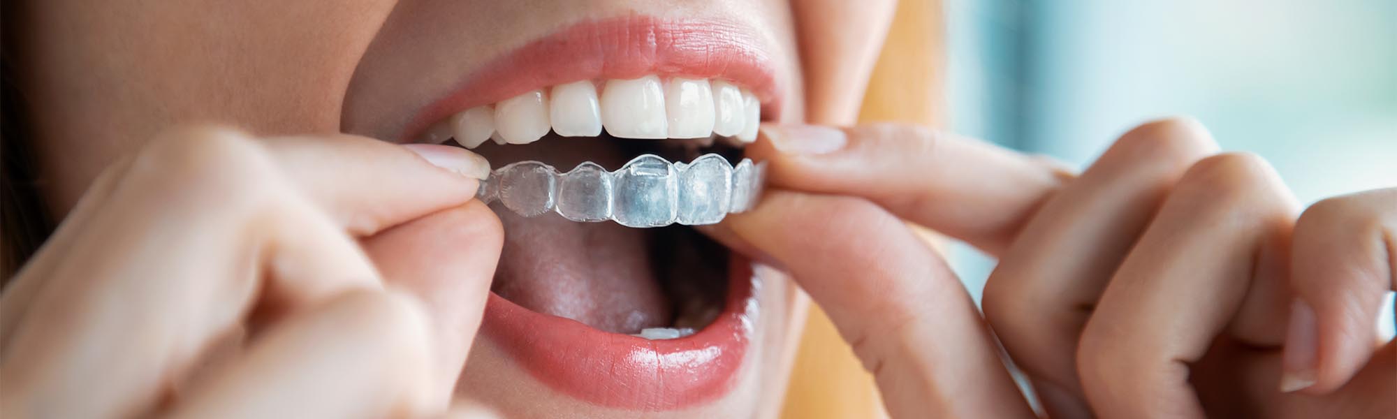Orthodontic Retainers Long Beach CA - Removable & Permanent Retainer